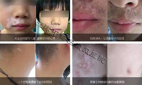 为什么我的白癜风总是治不好？